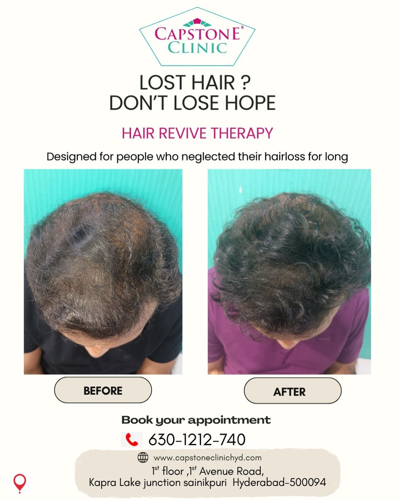 Male Pattern Crown Baldness Restored via Hair Revive Therapy
