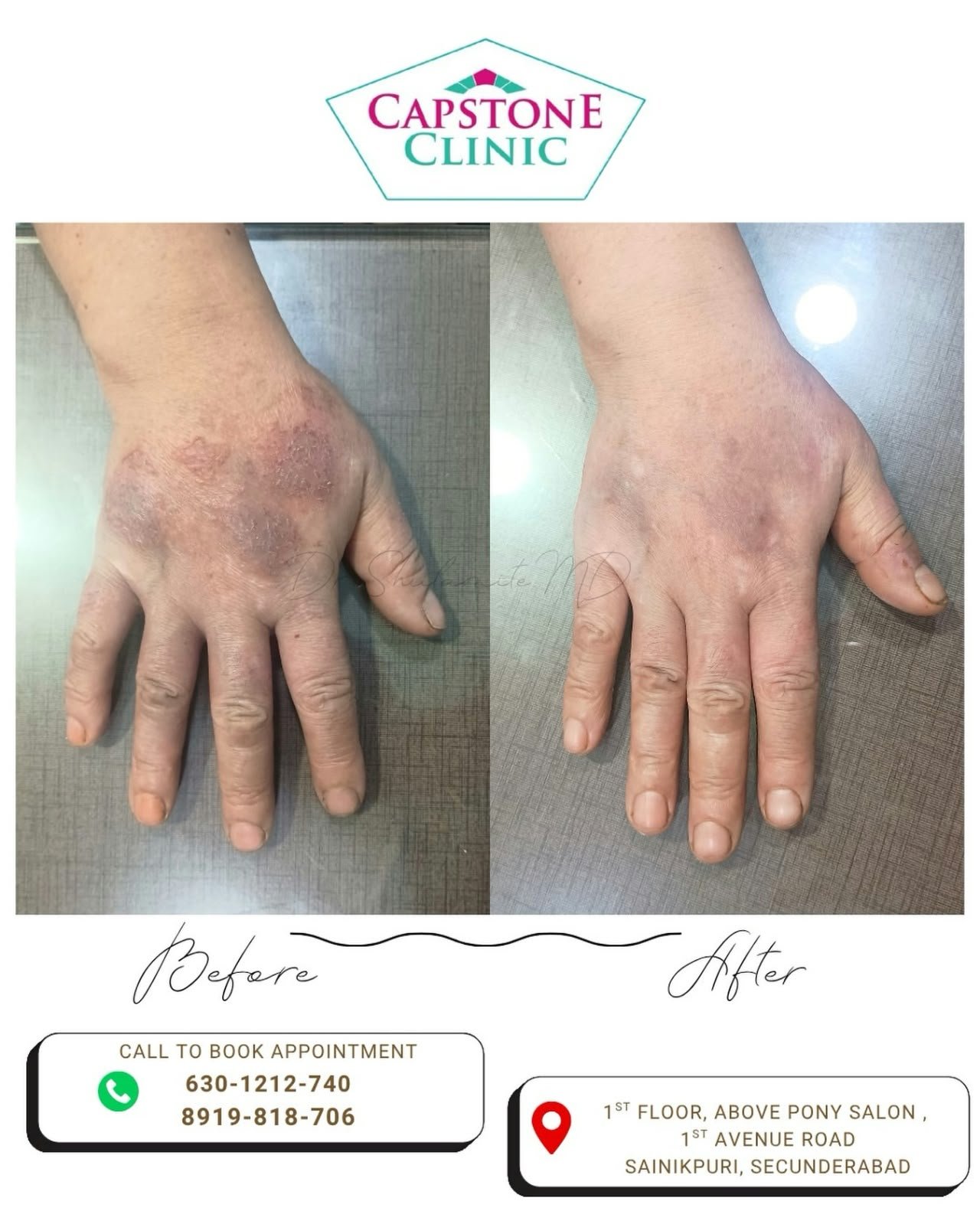 Allergy Care at Capstone Clinic
