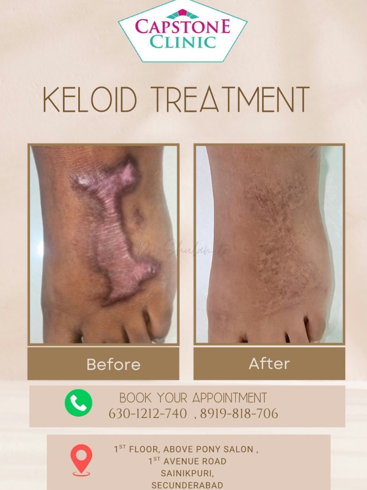 Hypertrophic Scar and Foot Keloid Flattening Before and After