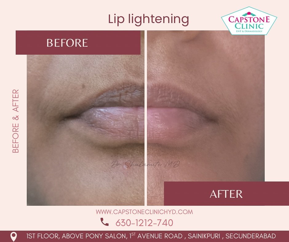Dark Lip Hyperpigmentation Toning Before and After
