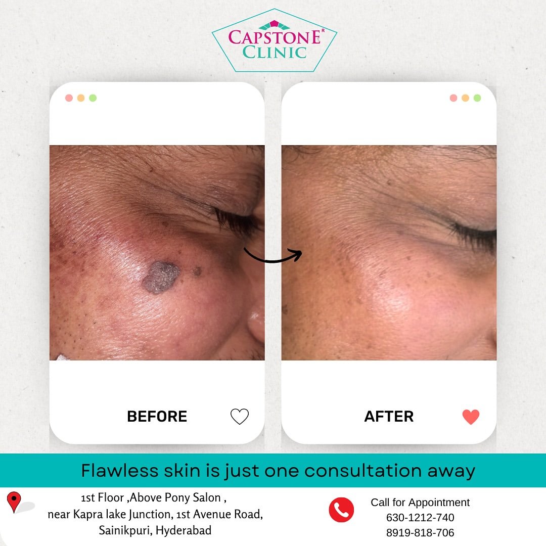 Facial Mole and Keratosis Radiofrequency Excision Before and After